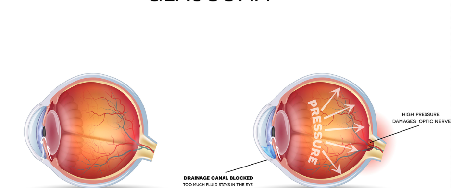 Diabetes and Eyes – Glaucoma